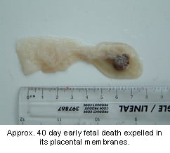 abortion-1