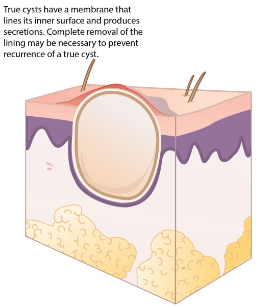 skin_cyst_2018-01