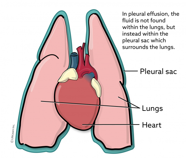 pleural_sac__2018-01