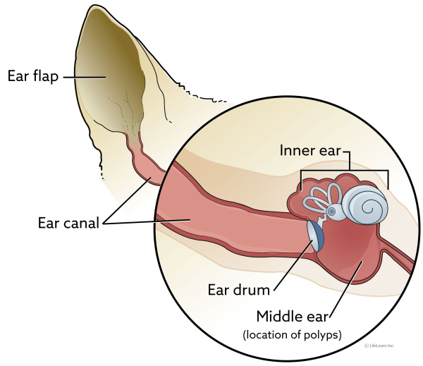earcanal_nasopharyngeal_polyps_2018-01 earcanal_nasopharyngeal_polyps_2018-01