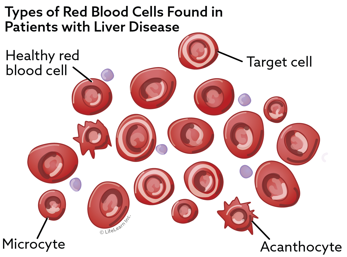 Types of red blood cells found in patients with liver disease: healthy cells, target cells, microcytes, and acanthocyes.