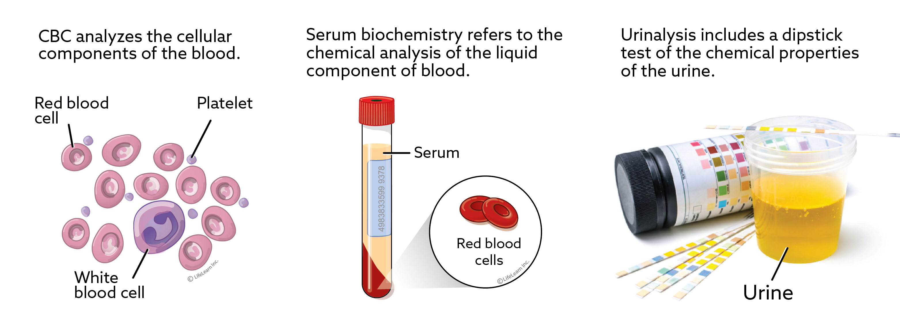Three-part illustration explains the common screening tests: complete blood test, serum biochemistry, and urinalysis. Part 1: A complete blood test (CBC) analyzes the cellular components of the blood. Illustration shows red blood cells, white blood cells, and platelet cells. Part 2: Serum biochemistry refers to the chemical analysis of the liquid component of blood that remains after the cells and clotting factors have been removed. Illustration shows a test tube with a small amount of red at the bottom (blood cells), and a pale-yellow liquid (serum) at the top. Part 3: Urinalysis includes a dipstick test of the chemical properties of the urine. Illustration shows a cup of urine and some small, paper dipsticks with stripes of various colors that will test for various chemicals in the urine.