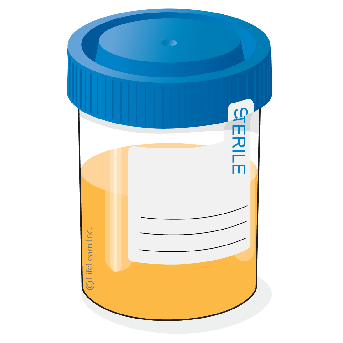 A cup is used to collect a urine sample for testing.