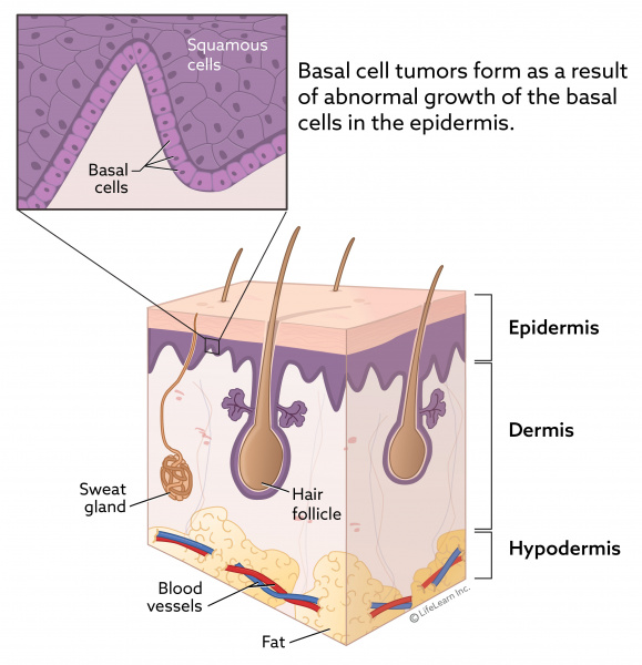 skin_layers_basalcell_2018 skin_layers_basalcell_2018