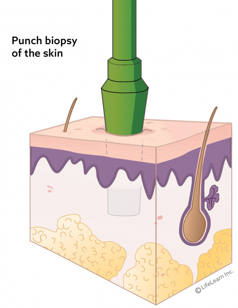 skin_layers_punch_biopsy_2018_002-01 skin_layers_punch_biopsy_2018_002-01