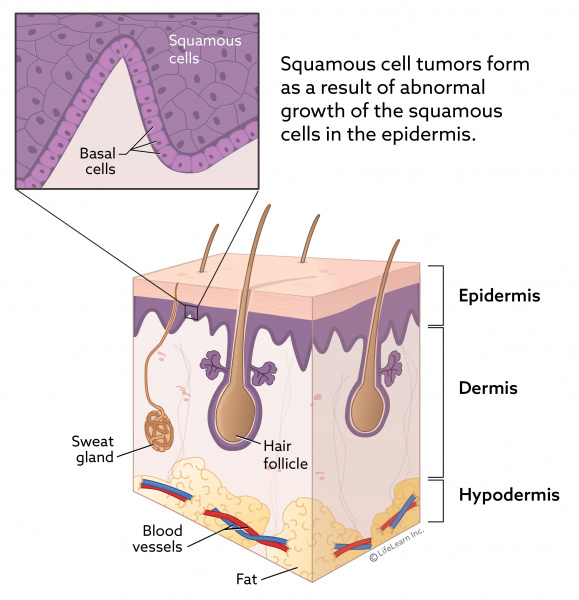 skin_layers_squamous_cell_2018 skin_layers_squamous_cell_2018
