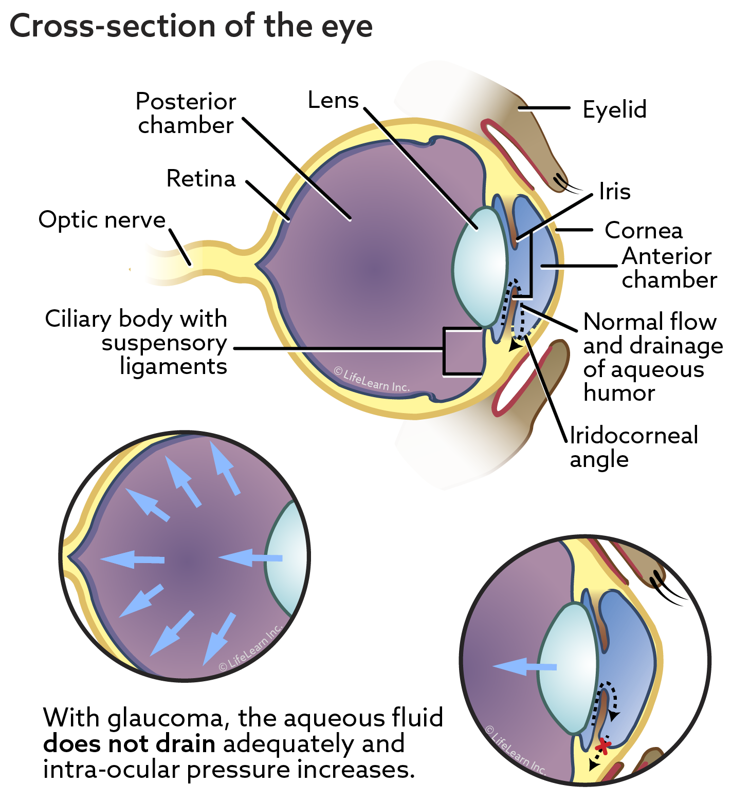 Illustration shows cross-section of the eye. With glaucoma, the aqueous fluid does not drain adequately and intra-ocular pressure increases.